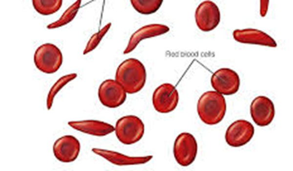 Sickle Cell Disease